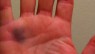 No more Bruised Hands